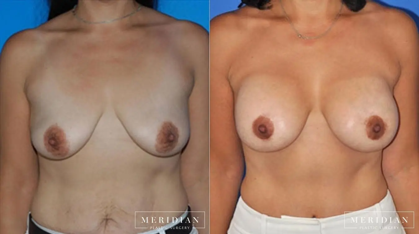 Breast Lift: Patient 7 - Before and After  