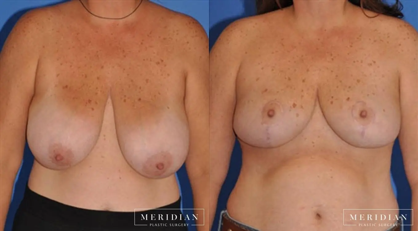 Breast Lift: Patient 10 - Before and After  