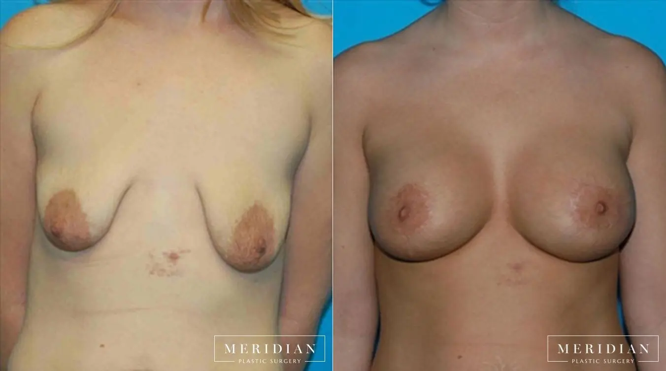 Breast Lift: Patient 8 - Before and After  