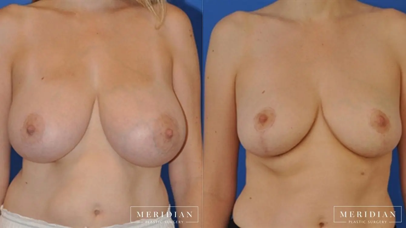 Breast Lift: Patient 9 - Before and After  