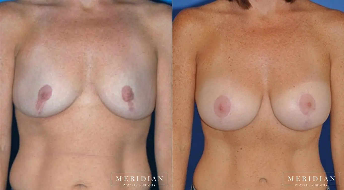 Breast Lift: Patient 6 - Before and After  