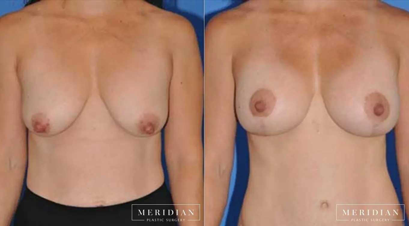 Breast Lift: Patient 5 - Before and After  