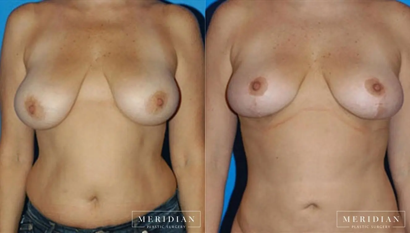 Breast Lift: Patient 2 - Before and After  