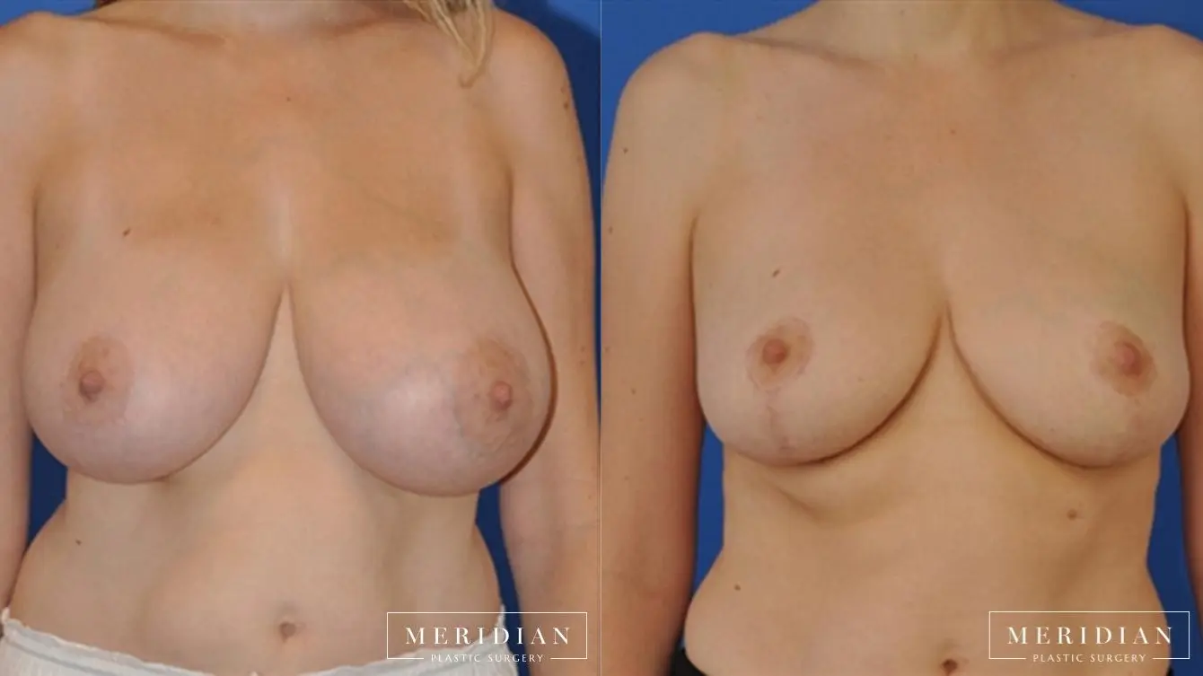 Breast Reduction: Patient 3 - Before and After  