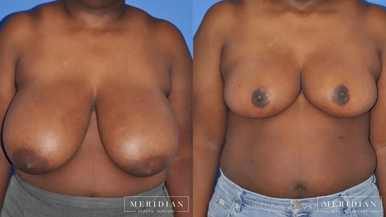 Breast Reduction: Patient 8 - Before and After  