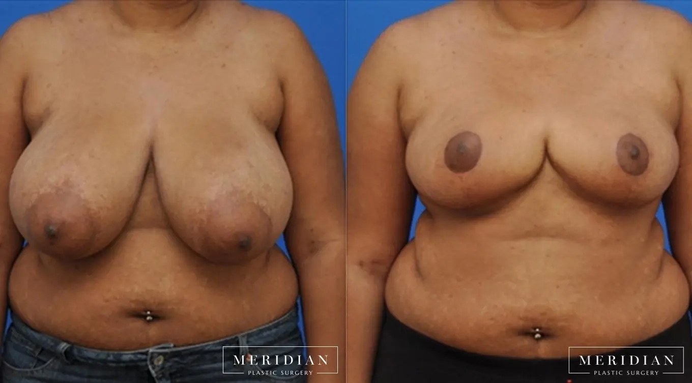 Breast Reduction: Patient 4 - Before and After  