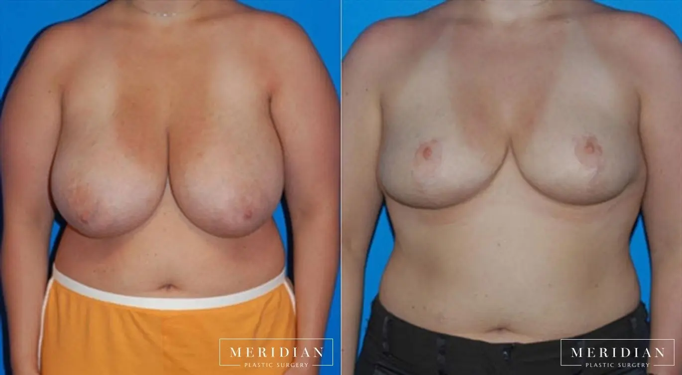 Breast Reduction: Patient 1 - Before and After  