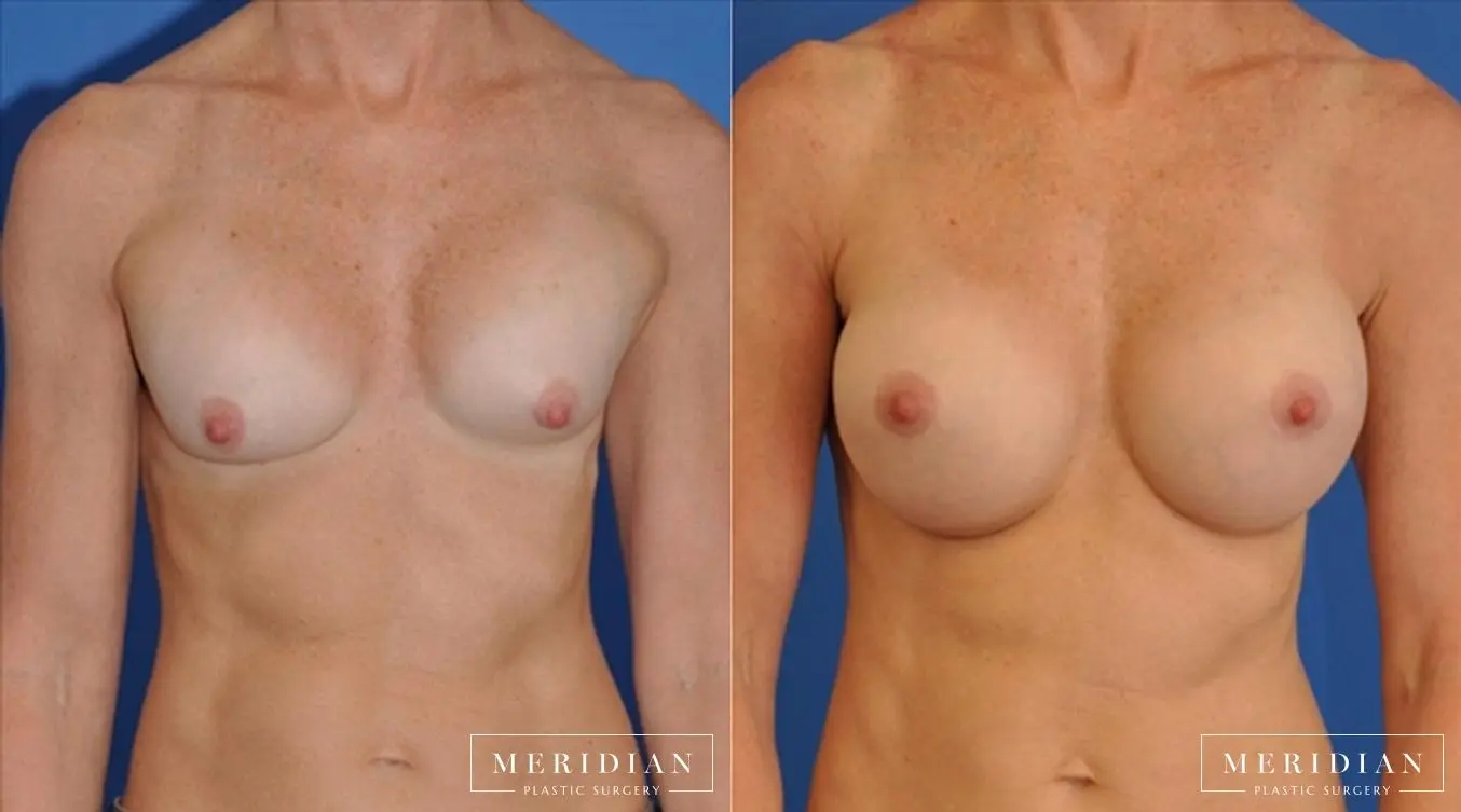 Breast Revision: Patient 7 - Before and After  