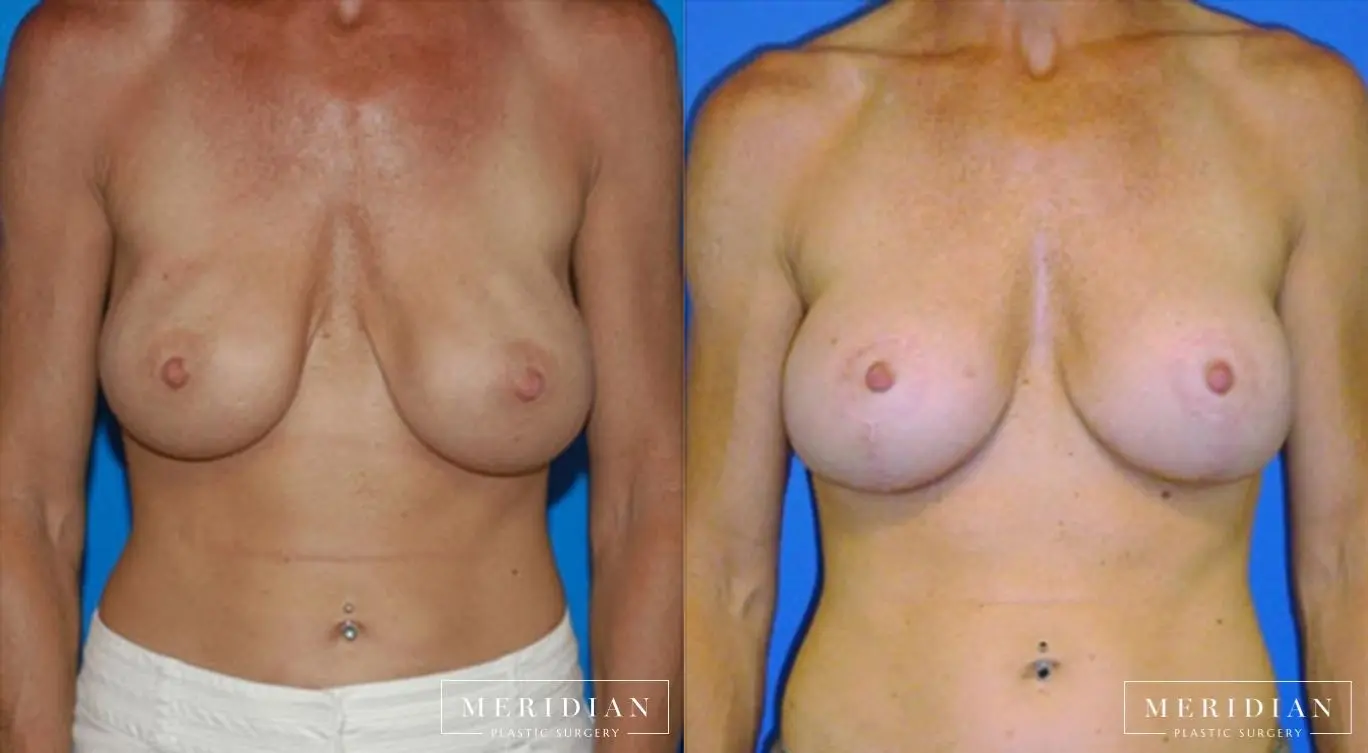 Breast Revision: Patient 6 - Before and After  