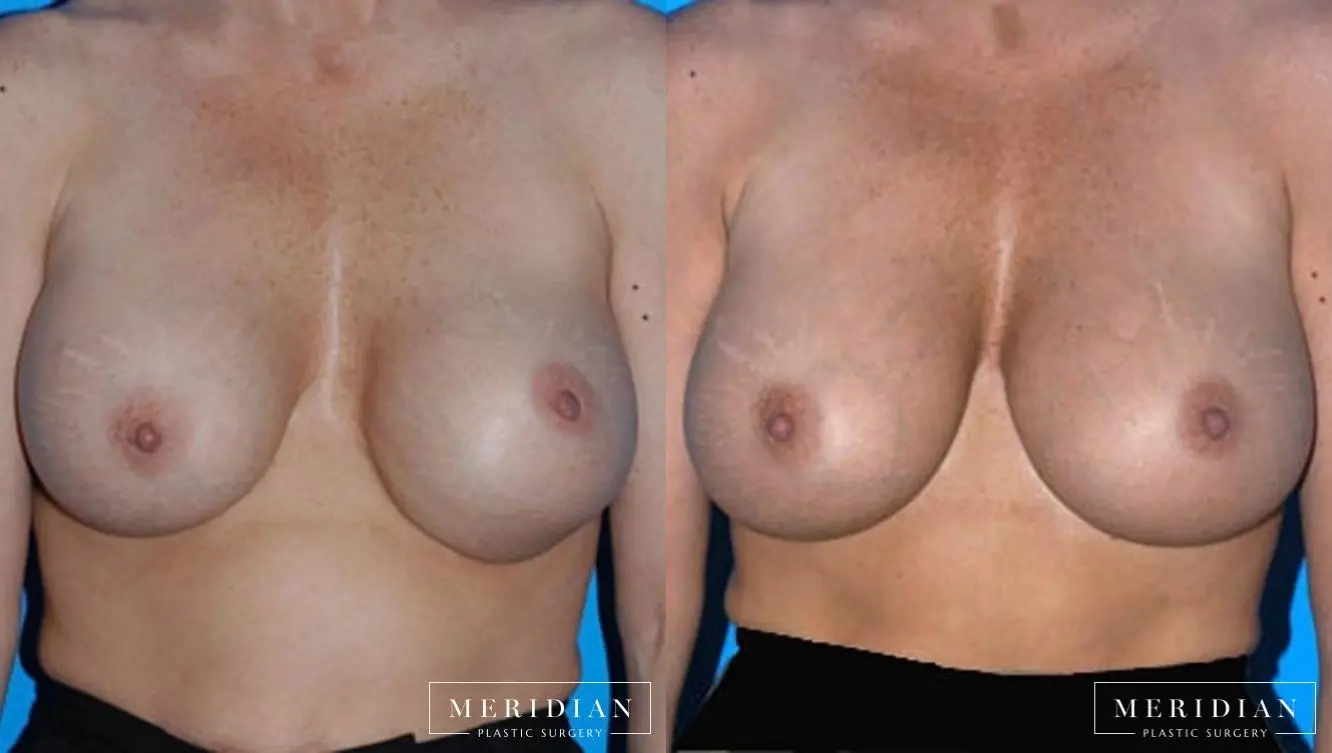 Breast Revision: Patient 3 - Before and After  