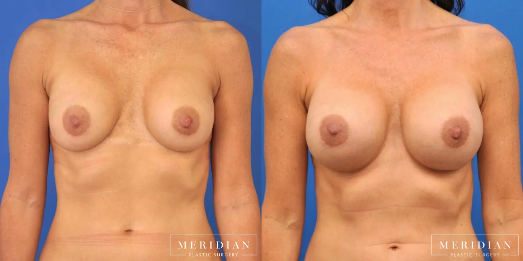 Breast Revision: Patient 1 - Before and After  