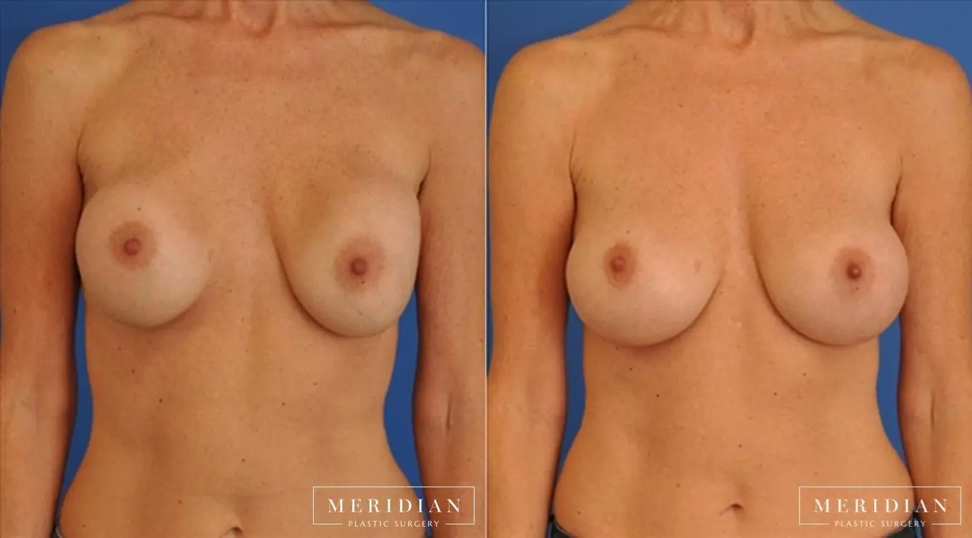 Breast Revision: Patient 4 - Before and After  