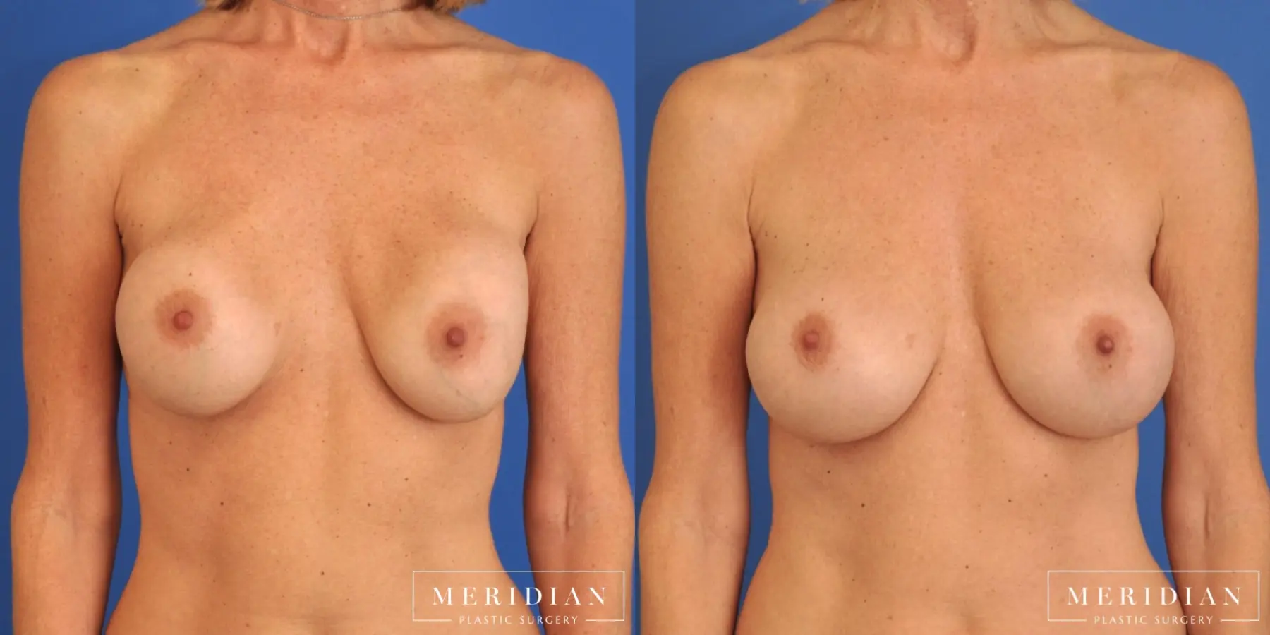 Breast Revision: Patient 2 - Before and After  