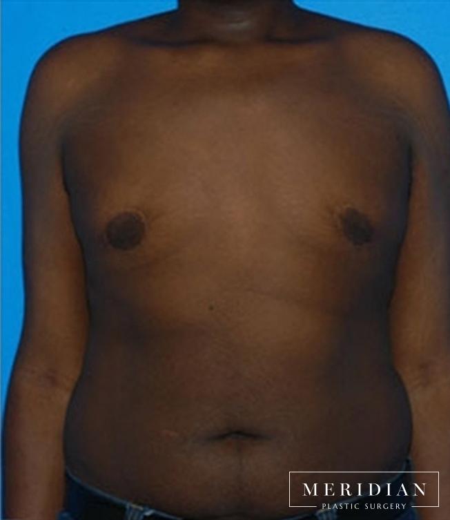 Gynecomastia: Patient 2 - After  