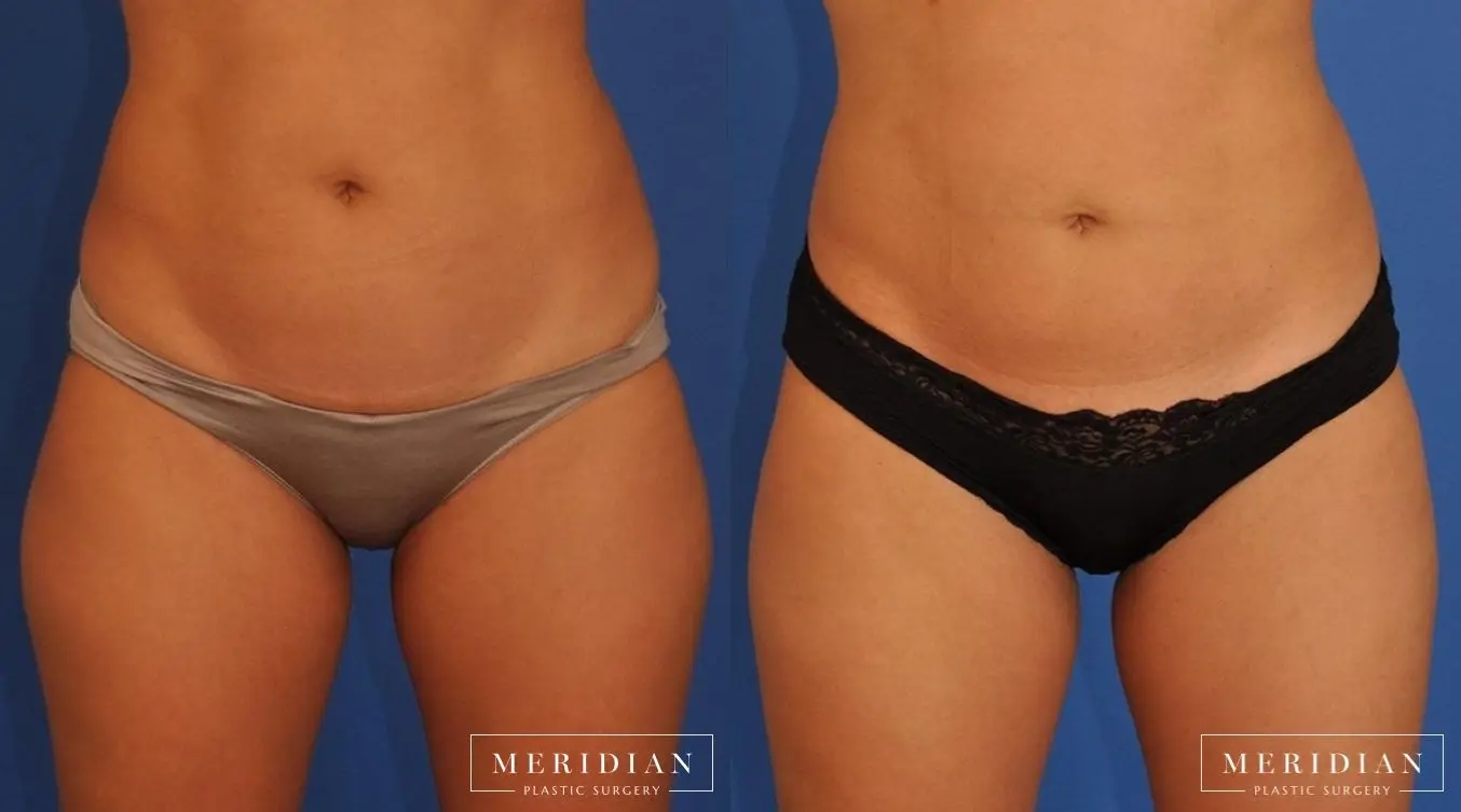 CoolSculpting®: Patient 1 - Before and After  