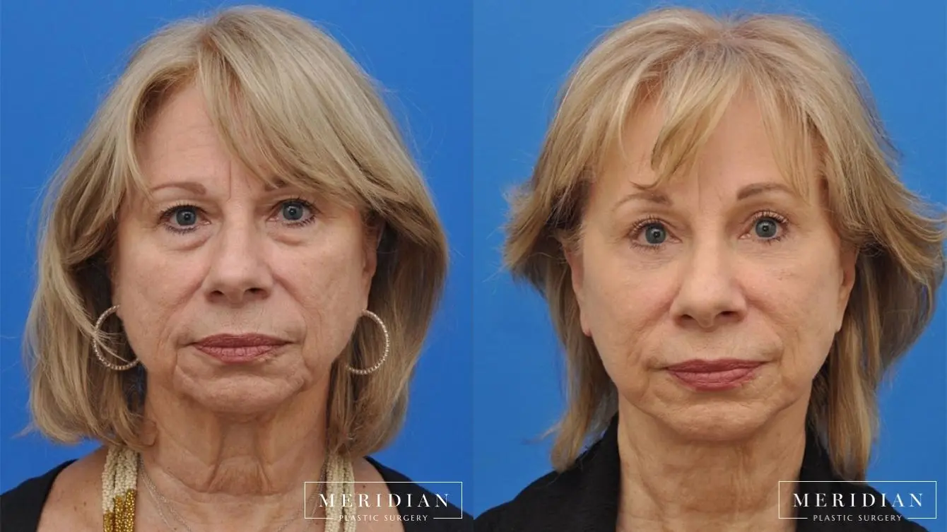 Eyelid Lift: Patient 6 - Before and After  