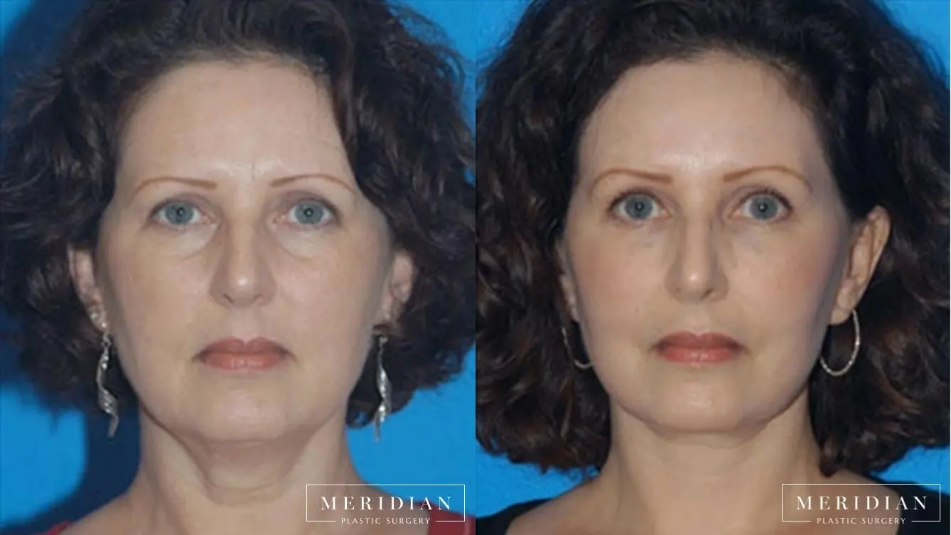 Eyelid Lift: Patient 4 - Before and After  