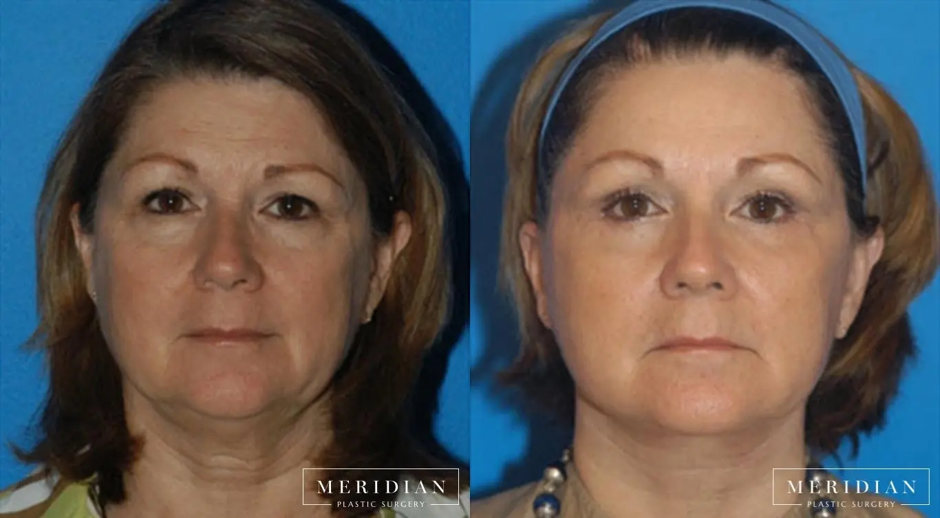 Eyelid Lift: Patient 1 - Before and After  