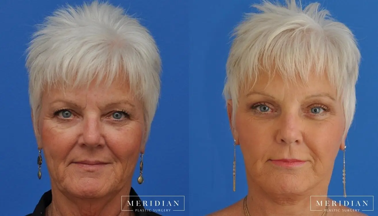 Eyelid Lift: Patient 7 - Before and After  