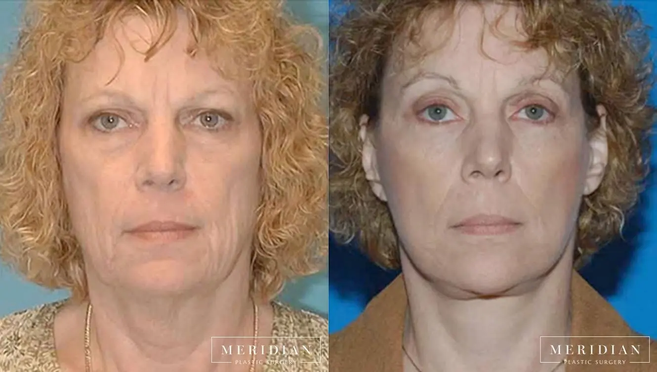 Eyelid Lift: Patient 3 - Before and After  