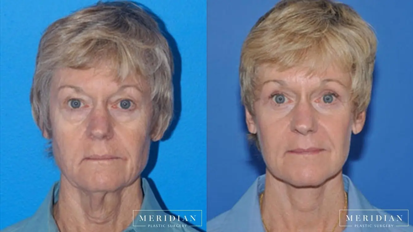 Facelift: Patient 5 - Before and After  