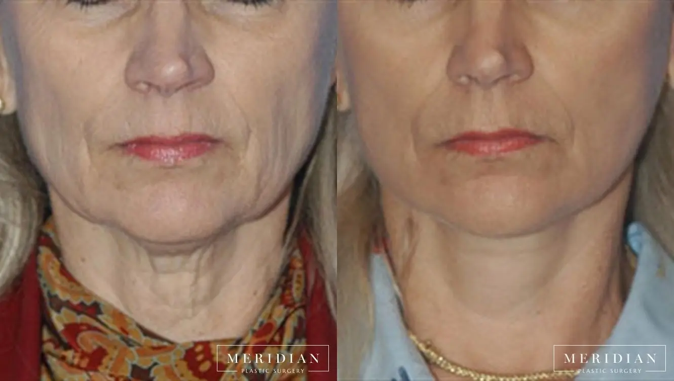 Facelift: Patient 2 - Before and After  