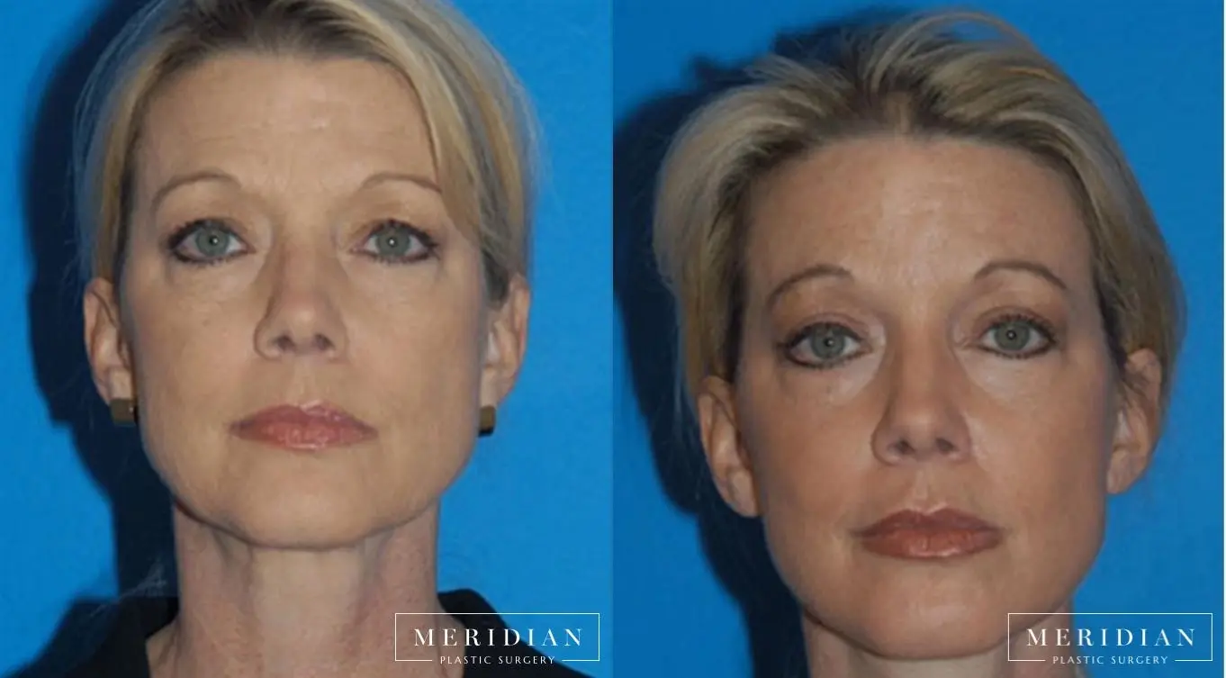 Facelift: Patient 7 - Before and After  