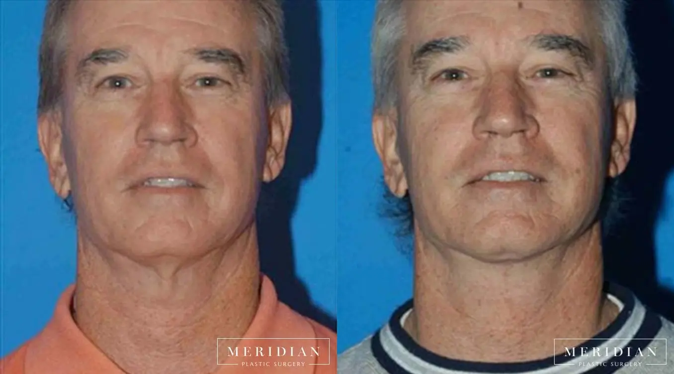 Facelift: Patient 3 - Before and After  