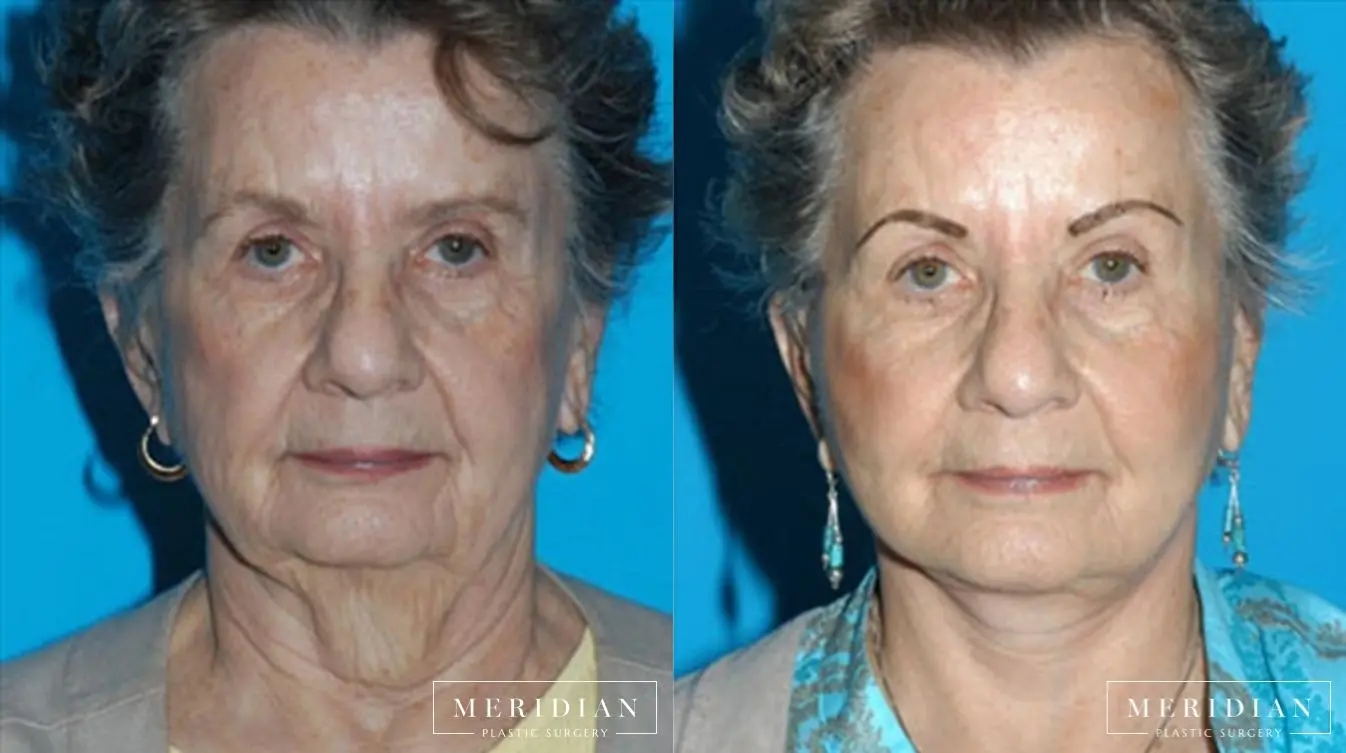 Facelift: Patient 6 - Before and After  