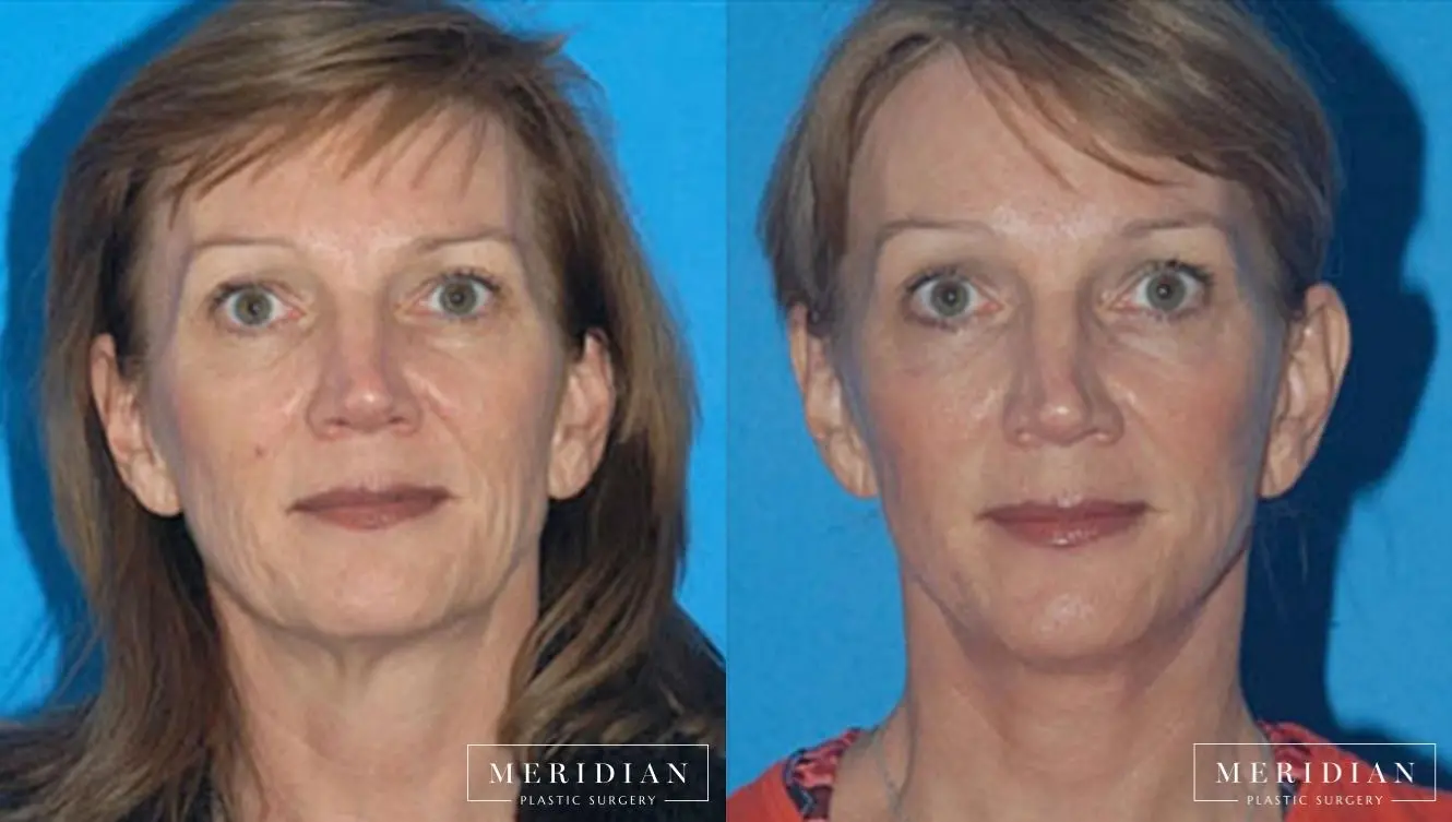 Facelift: Patient 9 - Before and After  