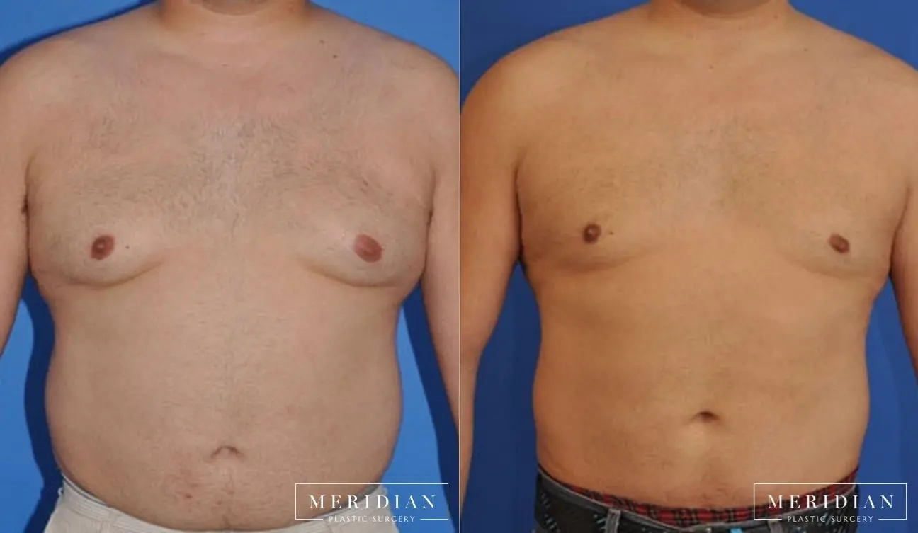 Gynecomastia: Patient 9 - Before and After  