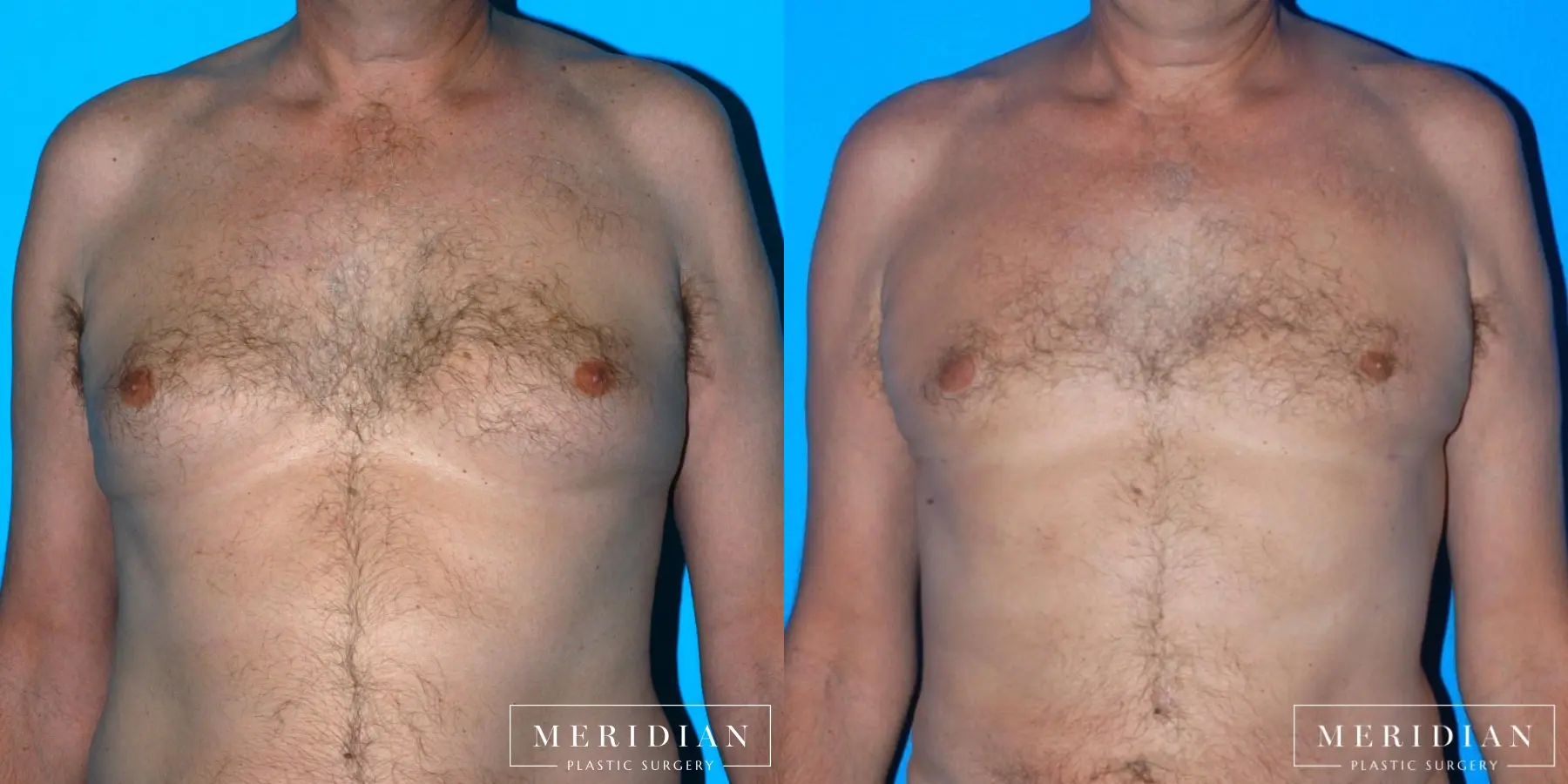 Gynecomastia: Patient 5 - Before and After  