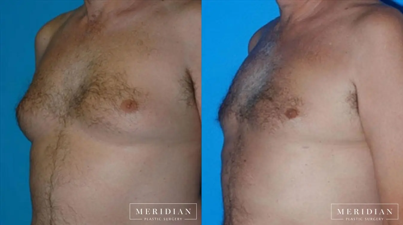 Gynecomastia: Patient 1 - Before and After  