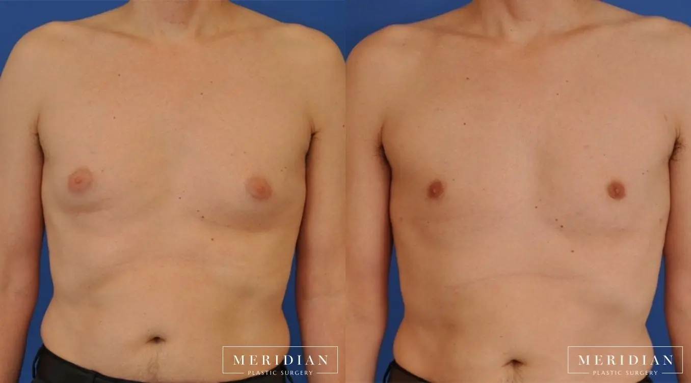 Gynecomastia: Patient 10 - Before and After  