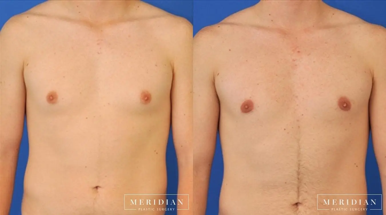 Gynecomastia: Patient 3 - Before and After  