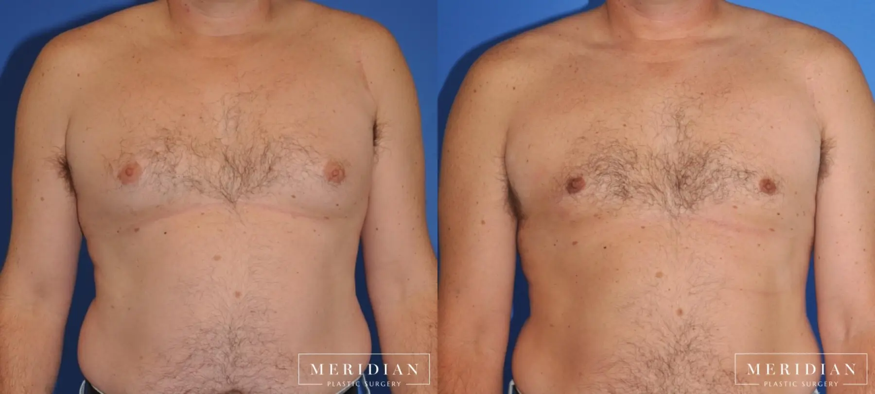 Gynecomastia: Patient 4 - Before and After  