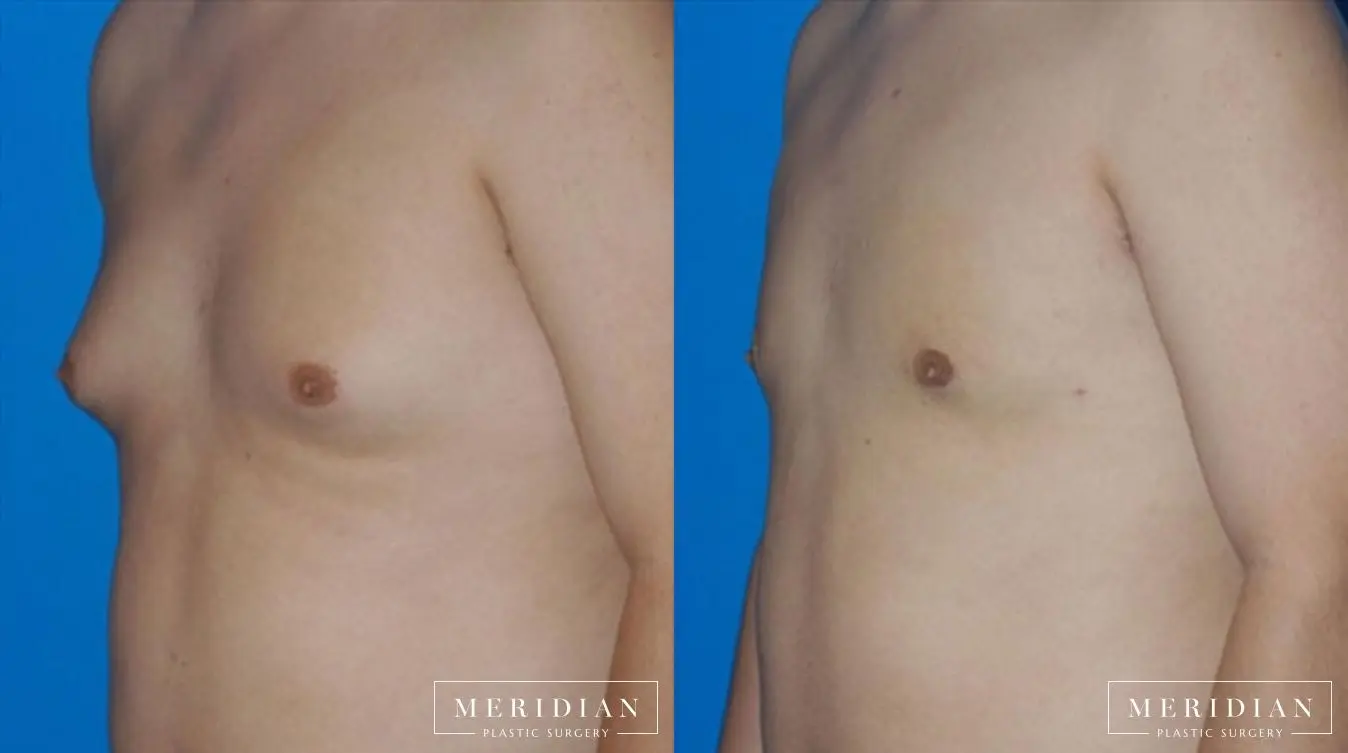 Gynecomastia: Patient 7 - Before and After  