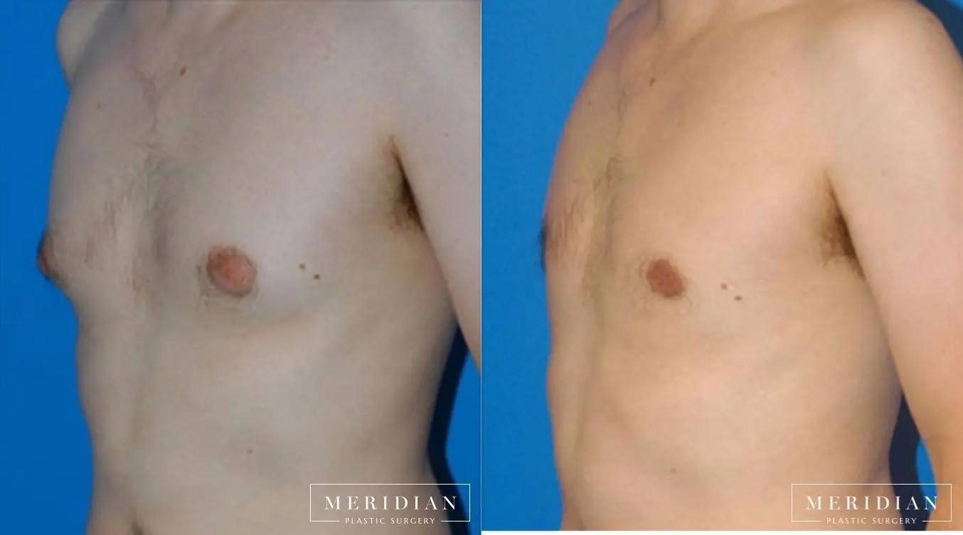 Gynecomastia: Patient 6 - Before and After  