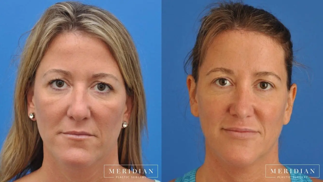 Injectables: Patient 3 - Before and After  