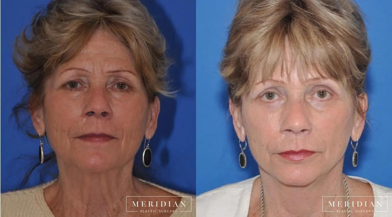 Injectables: Patient 4 - Before and After  