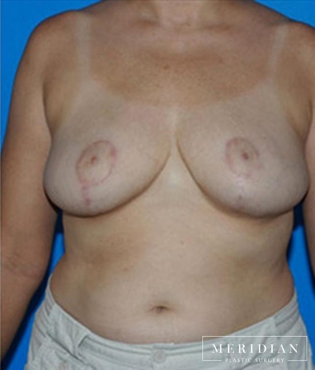 Breast Reduction: Patient 9 - After  