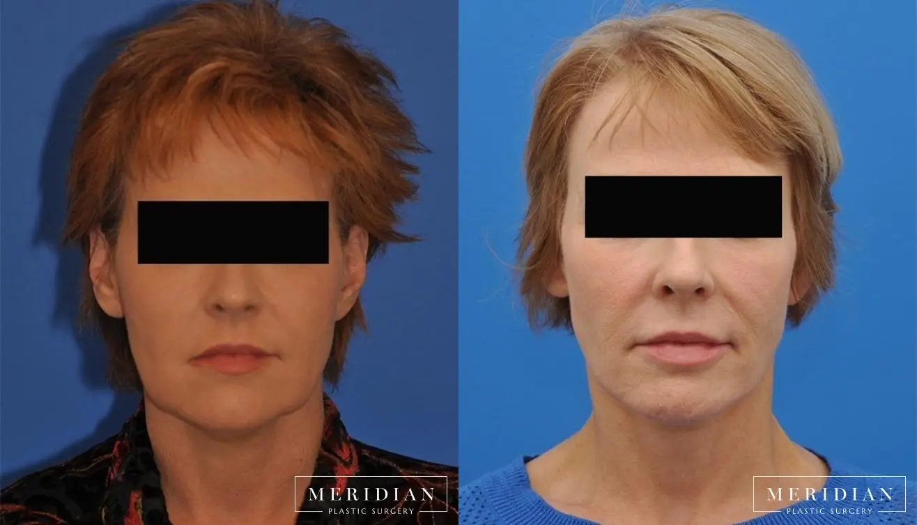 Neck Lift: Patient 7 - Before and After  