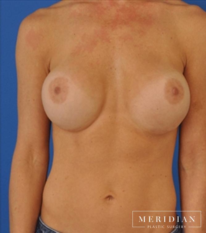 Breast Revision: Patient 9 - After  