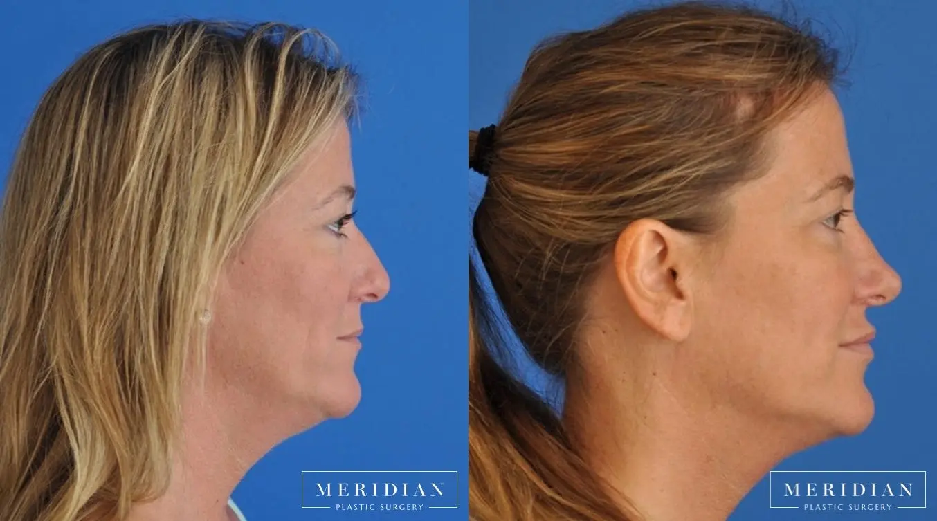 Rhinoplasty: Patient 4 - Before and After  