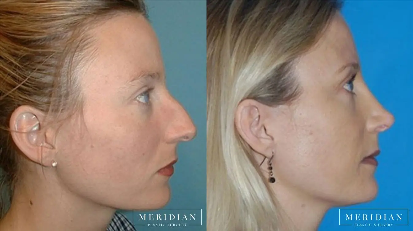 Rhinoplasty: Patient 1 - Before and After  