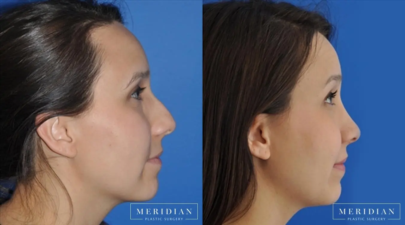 Rhinoplasty: Patient 3 - Before and After  