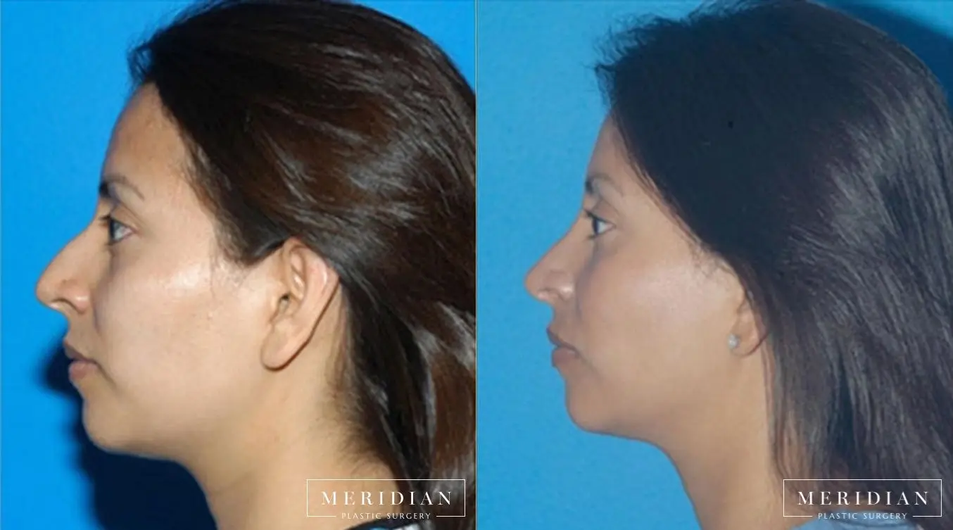 Rhinoplasty: Patient 2 - Before and After  