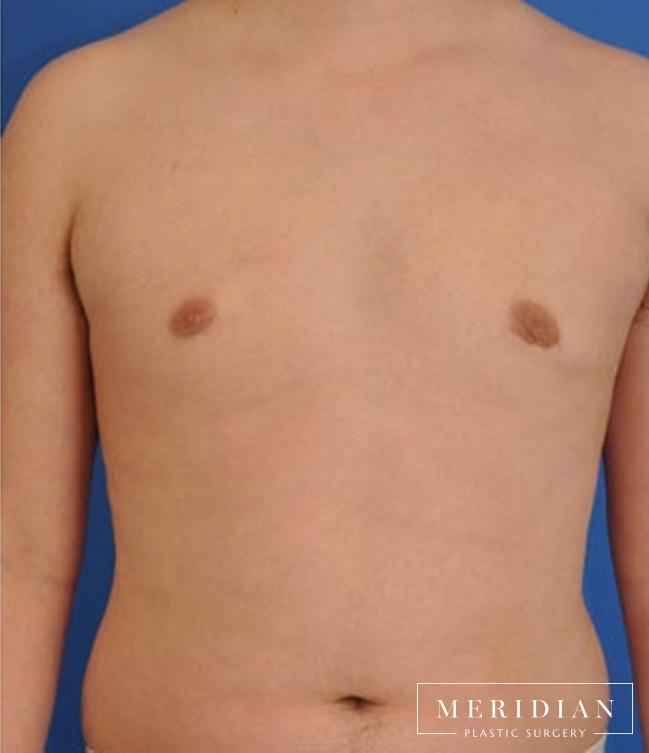 Gynecomastia: Patient 8 - After  