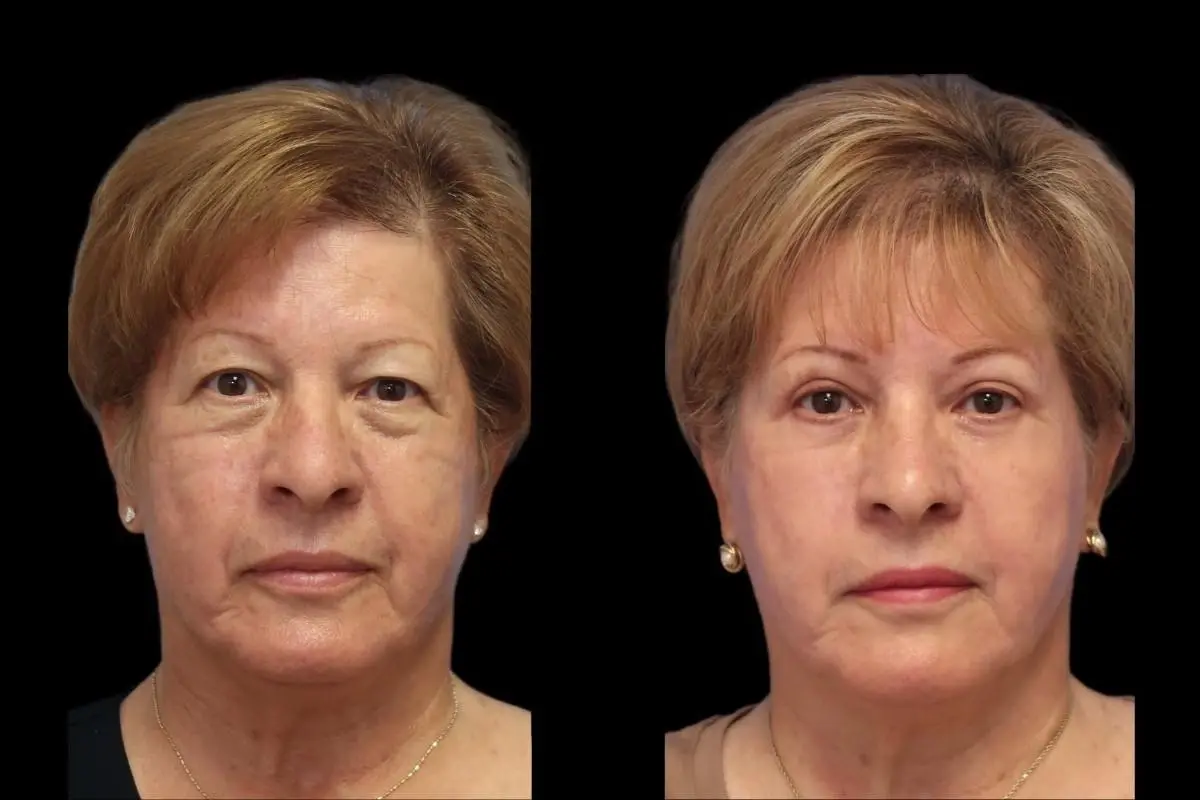 Blepharoplasty: Patient 5 - Before and After  