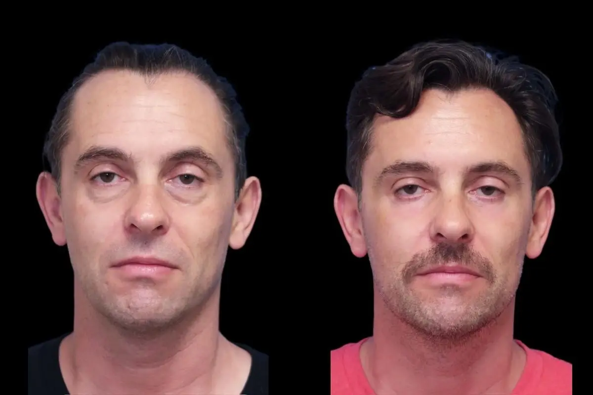 Blepharoplasty: Patient 4 - Before and After  